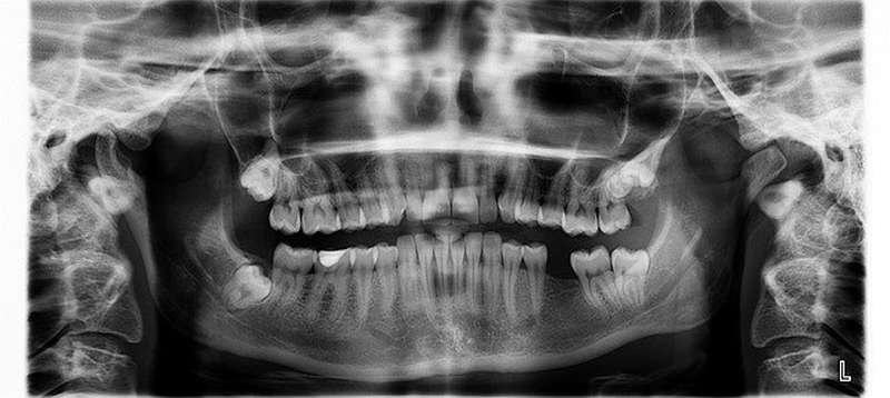  zobni rentgen